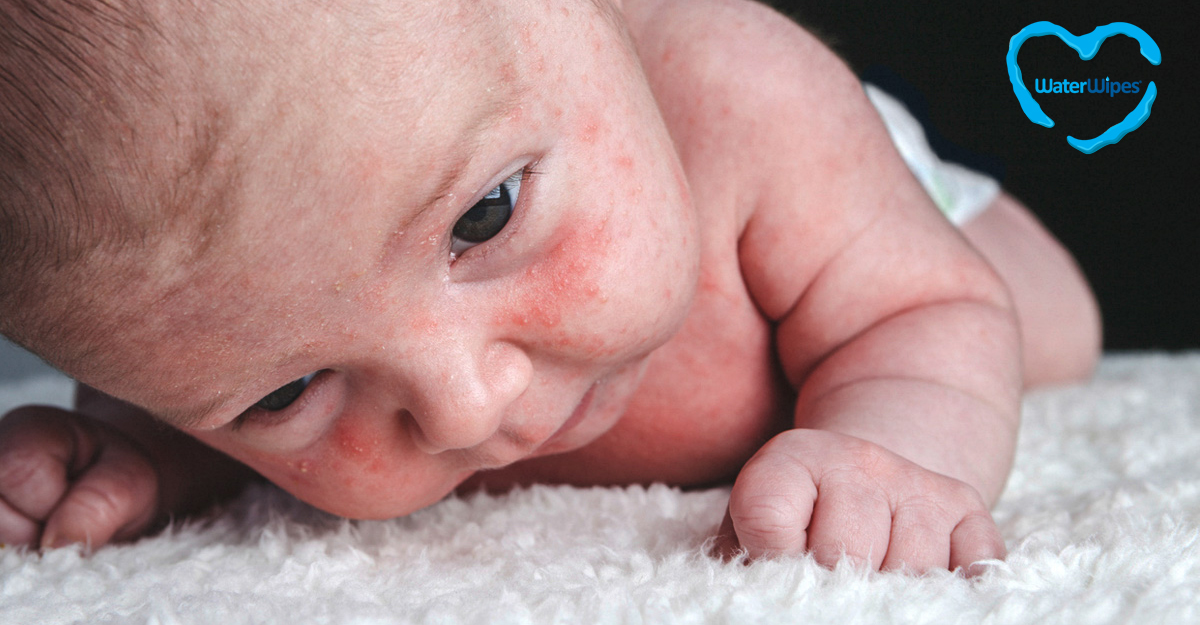 Kiütések, foltok a csecsemő bőrén – mi okozhatja?